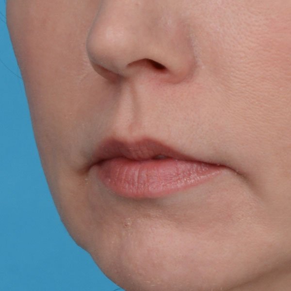 before lip lift front view female left angle view case 8517