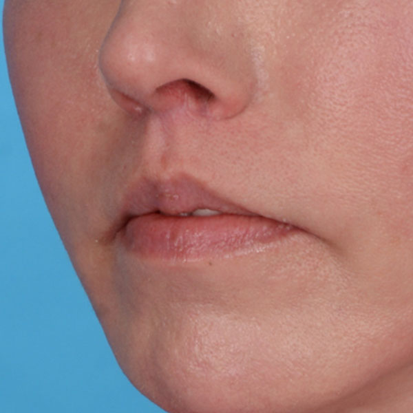 after lip lift front view female left angle view case 8517