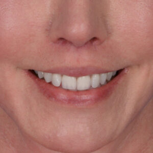 after lip lift front view female patient case 8517