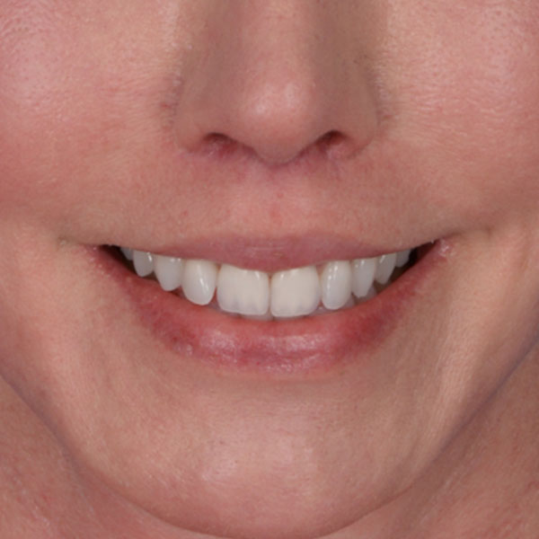 after lip lift front view female patient case 8517