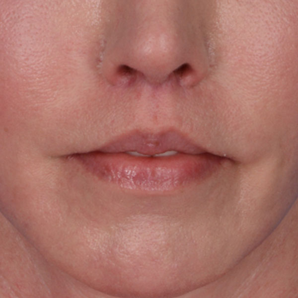after lip lift front view female patient no smile case 8517