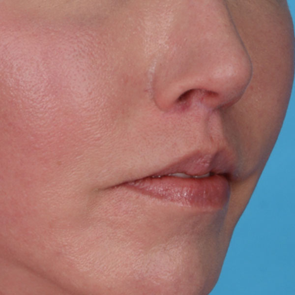 after lip lift front view female right angle view case 8517