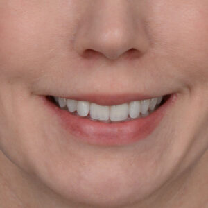 before lip lift front view female patient case 8517