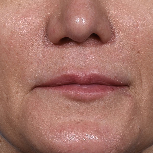 before lip lift front view female patient no smile case 8528
