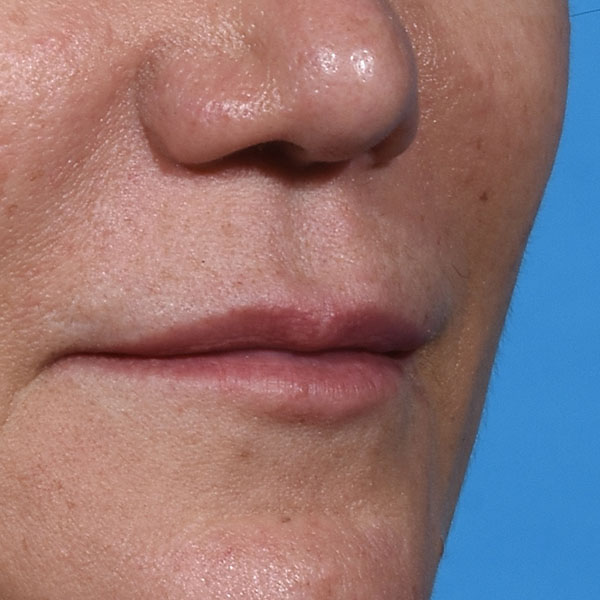 before lip lift front view female right angle view case 8528