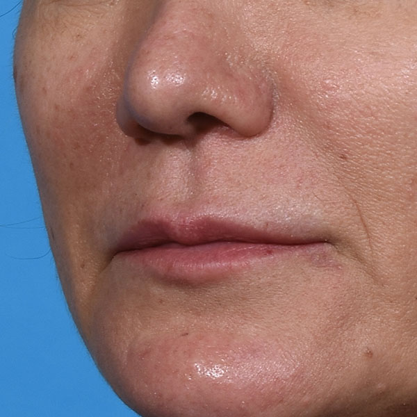 before lip lift front view female left angle view case 8528