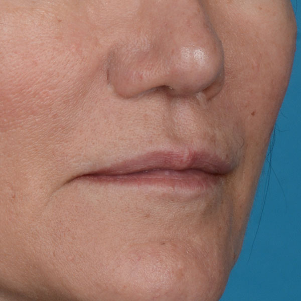 after lip lift front view female right angle view case 8528