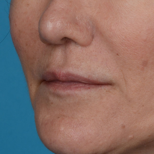 after lip lift front view female left angle view case 8528