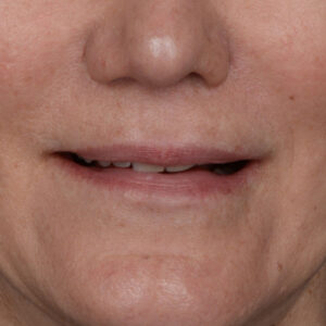 after lip lift front view female patient case 8528