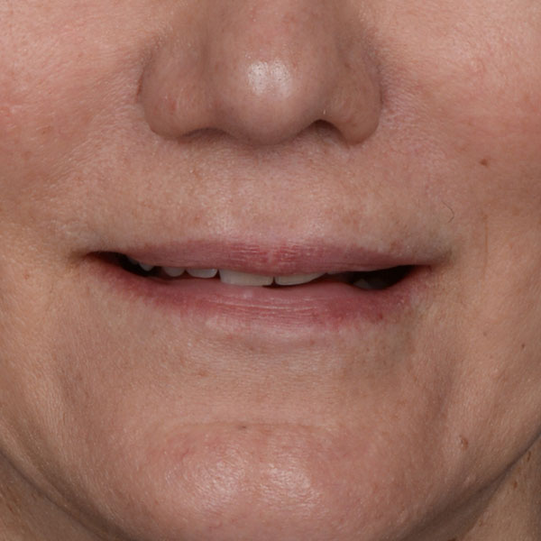 after lip lift front view female patient case 8528