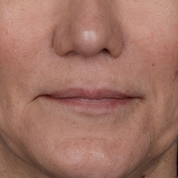 after lip lift front view female patient no smile case 8528