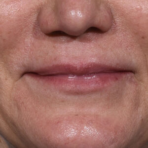 before lip lift front view female patient case 8528