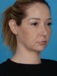 before neck lift right angle view female patient case 8279