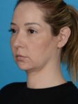 before neck lift left angle view female patient case 8279