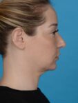before neck lift right side view female patient case 8279