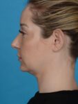 before neck lift left side view female patient case 8279