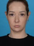 before neck lift front view no smile female patient case 8279