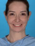 after neck lift front view female patient case 8279