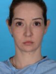 after neck lift front view no smile female patient case 8279