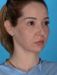 after neck lift right angle view female patient case 8279