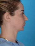 after neck lift right side view female patient case 8279