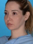 after neck lift left angle view female patient case 8279