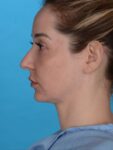 after neck lift left side view female patient case 8279