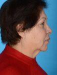 before neck lift right side female patient case 8341