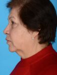 before neck lift left side female patient case 8341