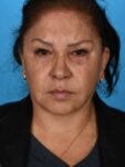 after neck lift front view female no smile patient case 8341