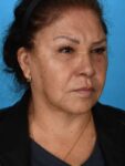 after neck lift right angle female patient case 8341