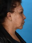 after neck lift right side female patient case 8341