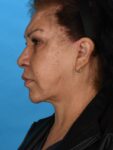 after neck lift left angle female patient case 8341