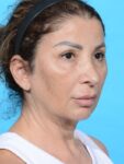 before neck lift right angle female patient case 8355