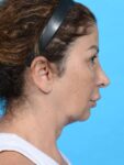 before neck right right side female patient case 8355