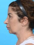 before neck lift left side female patient case 8355