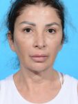 before neck lift front view female no smile patient case 8355