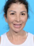 before neck lift front view female patient case 8355