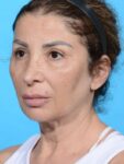 before neck lift left angle female patient case 8355