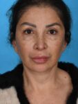 after neck lift front view female no smile patient case 8355