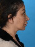 after neck right right side female patient case 8355