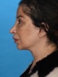 after neck lift left side female patient case 8355