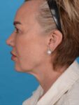 before neck lift left side female patient case 8368