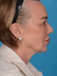 before neck lift right side female patient case 8368