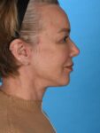 after neck lift right side female patient case 8368