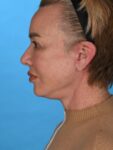 after neck lift left side female patient case 8368