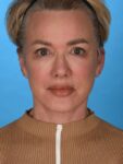 after neck lift front view female no smile patient case 8368