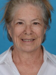 before neck lift front view female patient case 8381