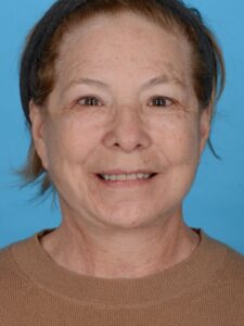 after neck lift front view female patient case 8381