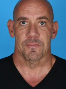 before neck lift front view male patient case 8408